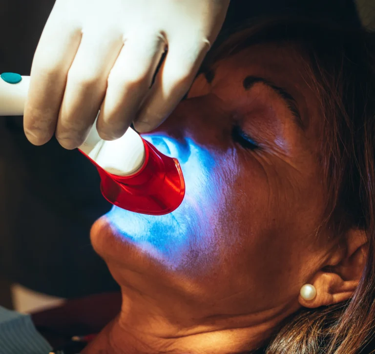 Fluoride treatment with curing light