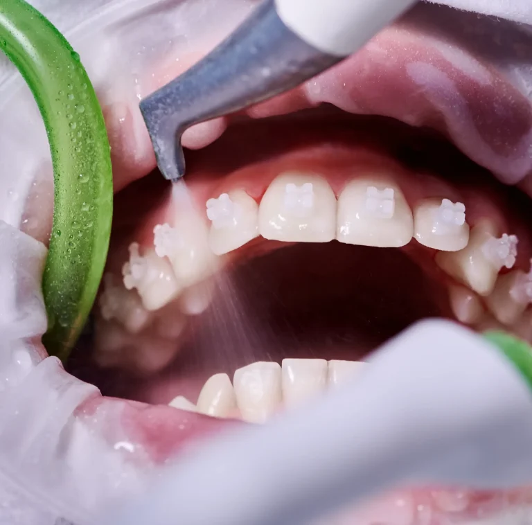 Professional teeth cleaning procedure