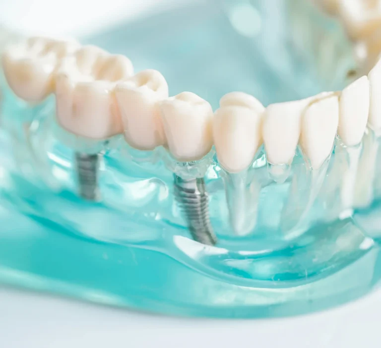 Implant supported full dentures
