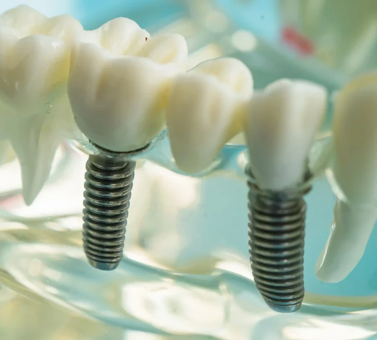 Full arch implant restoration
