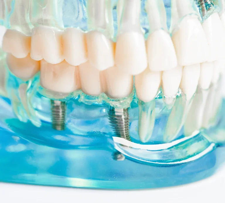 All-on-4 teeth replacement