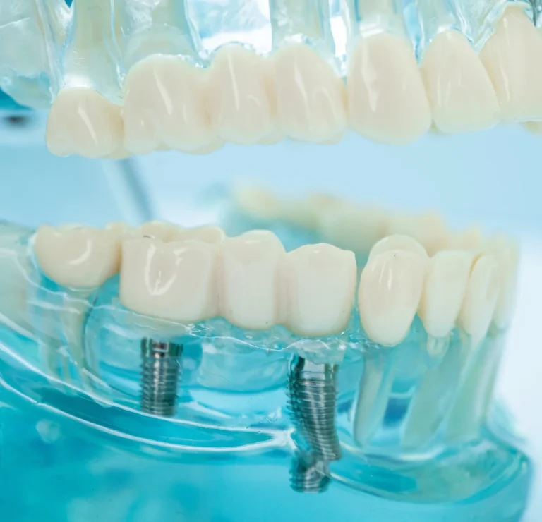 Full arch dental implants