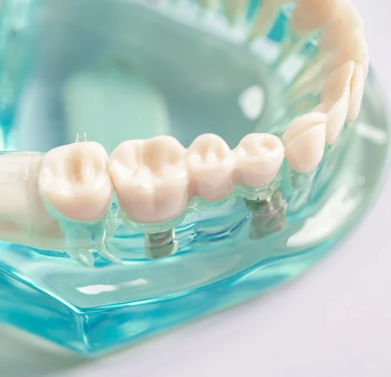 Implant supported teeth demonstration