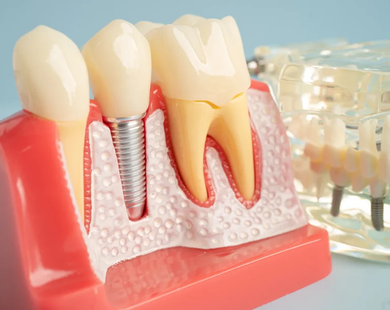 Implant supported tooth replacements