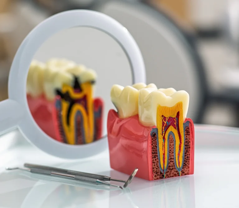 Tooth decay and filling example