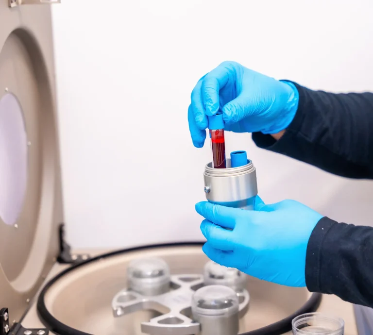 Blood sample preparation for PRF
