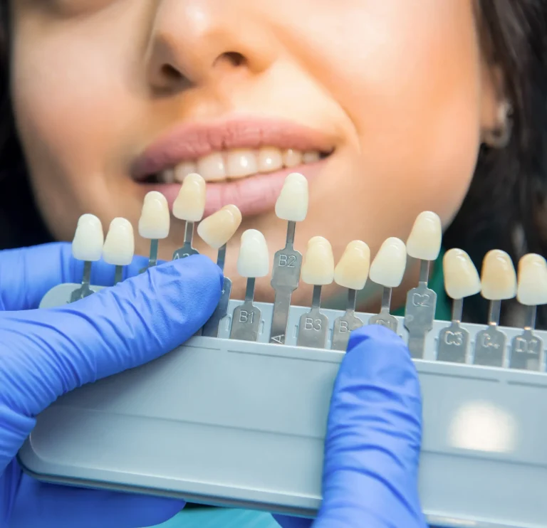 Dental shade matching procedure