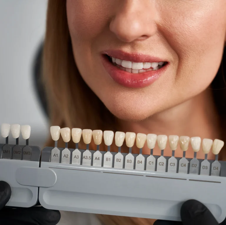 Cosmetic veneer consultation
